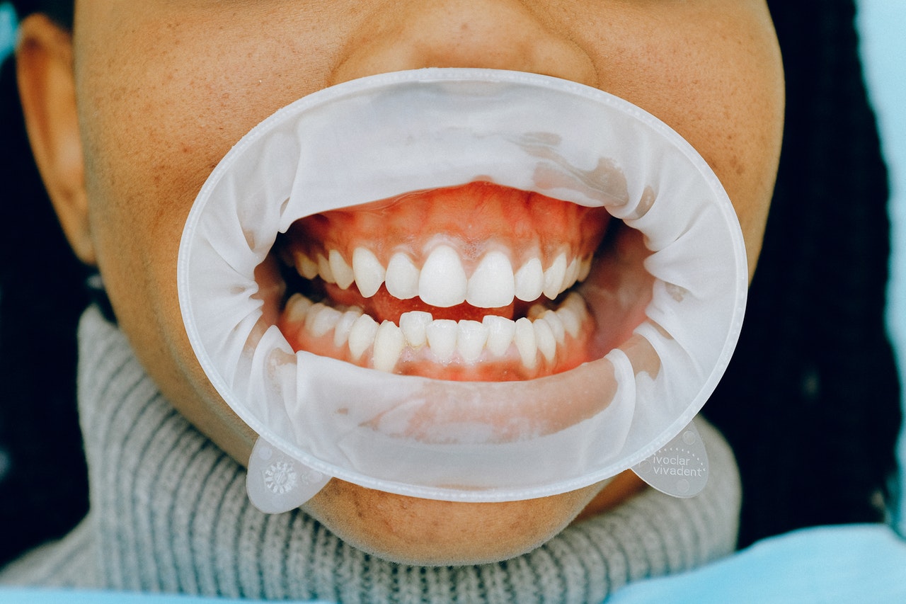 Composite Bonding & Veneers